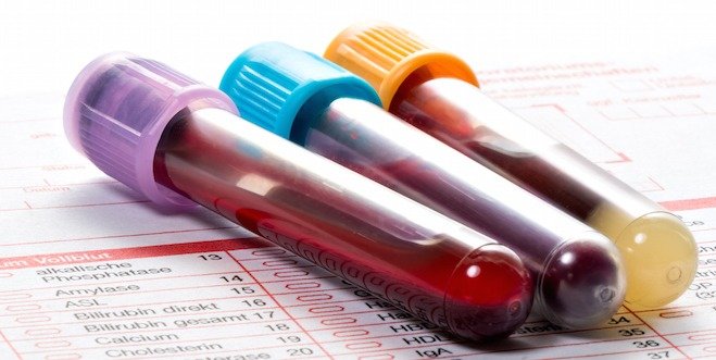 Blood test, blood samples on a laboratory form blood test