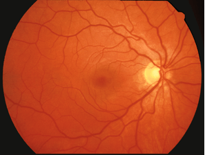 Normal retina