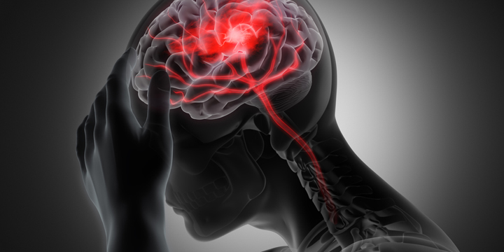 Brain stroke - conceptual artwork - 3d illustration