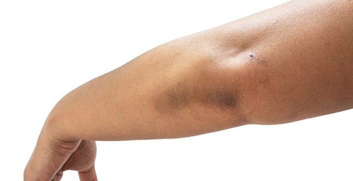 acanthosis nigricans